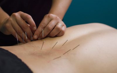 Dry Needling ili suva punkcija