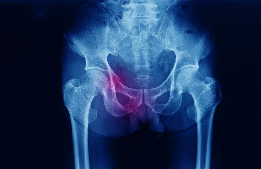 Bolovi u nogama iznad koljena: Uzrok, simptomi i kako ju točno liječiti?